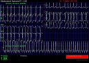 Ps plemena: Veterinrn poradna > Fibrilace sn (Veterinrn zkroky)